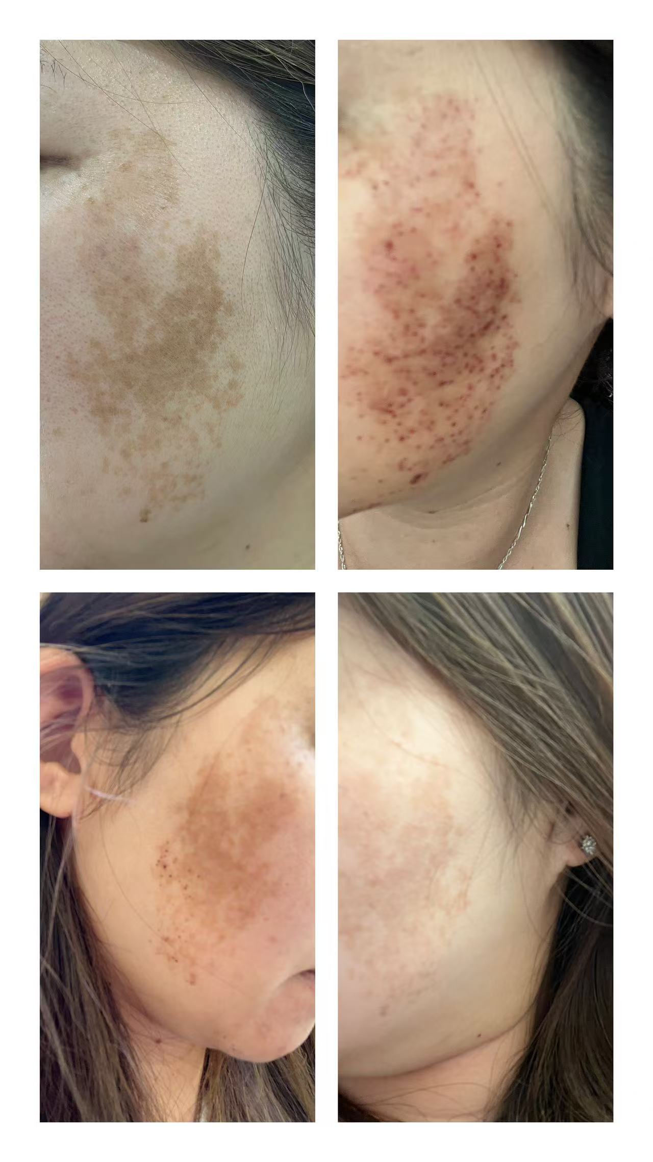 祛斑美容前后对比